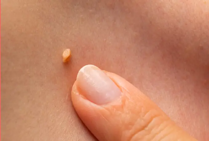 Що таке папілома?